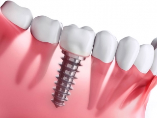 Những đối tượng phù hợp với phương pháp trồng răng implant