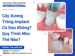 Cấy Xương Trồng Implant Có Đau Không? Quy Trình Như Thế Nào?