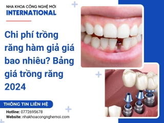 Chi phí trồng răng hàm giả giá bao nhiêu? Bảng giá trồng răng 2024