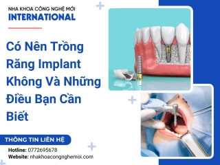 Có Nên Trồng Răng Implant Không Và Những Điều Bạn Cần Biết
