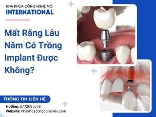 Mất Răng Lâu Năm Có Trồng Implant Được Không?