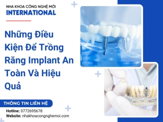 Những Điều Kiện Để Trồng Răng Implant An Toàn Và Hiệu Quả