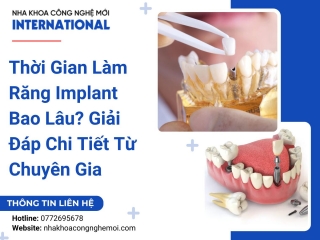 Thời Gian Làm Răng Implant Bao Lâu? Giải Đáp Chi Tiết Từ Chuyên Gia