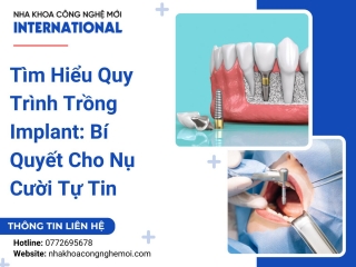 Tìm Hiểu Quy Trình Trồng Implant: Bí Quyết Cho Nụ Cười Tự Tin