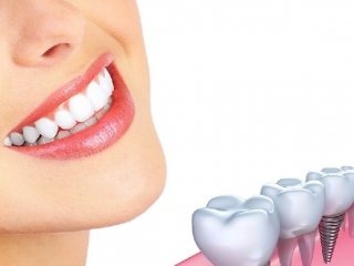 Trồng răng implant có nguy hiểm không?