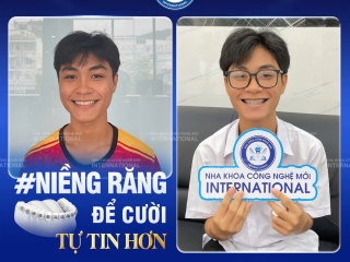NIỀNG RĂNG MẮC CÀI