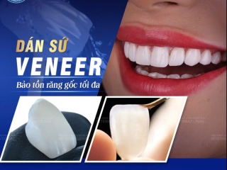 MẶT DÁN VENEER - CHẠM ĐẾN NỤ CƯỜI HOÀN MỸ