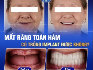 MẤT TOÀN BỘ RĂNG - TRỒNG RĂNG IMPLANT