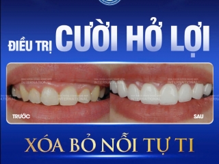 công nghệ điều trị cười hở lợi bằng Laser