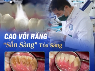 CẠO VÔI RĂNG ĐÁNH BAY MẢNG BÁM - LÀM MỚI NỤ CƯỜI