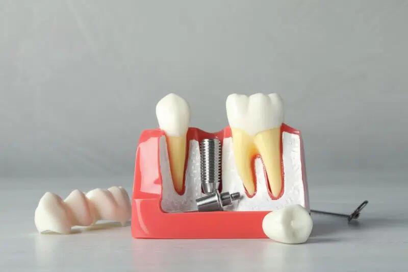 Số lượng trụ Implant cấy ghép cùng lúc