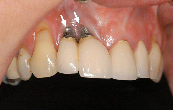 Đào thải sau cấy ghép Implant