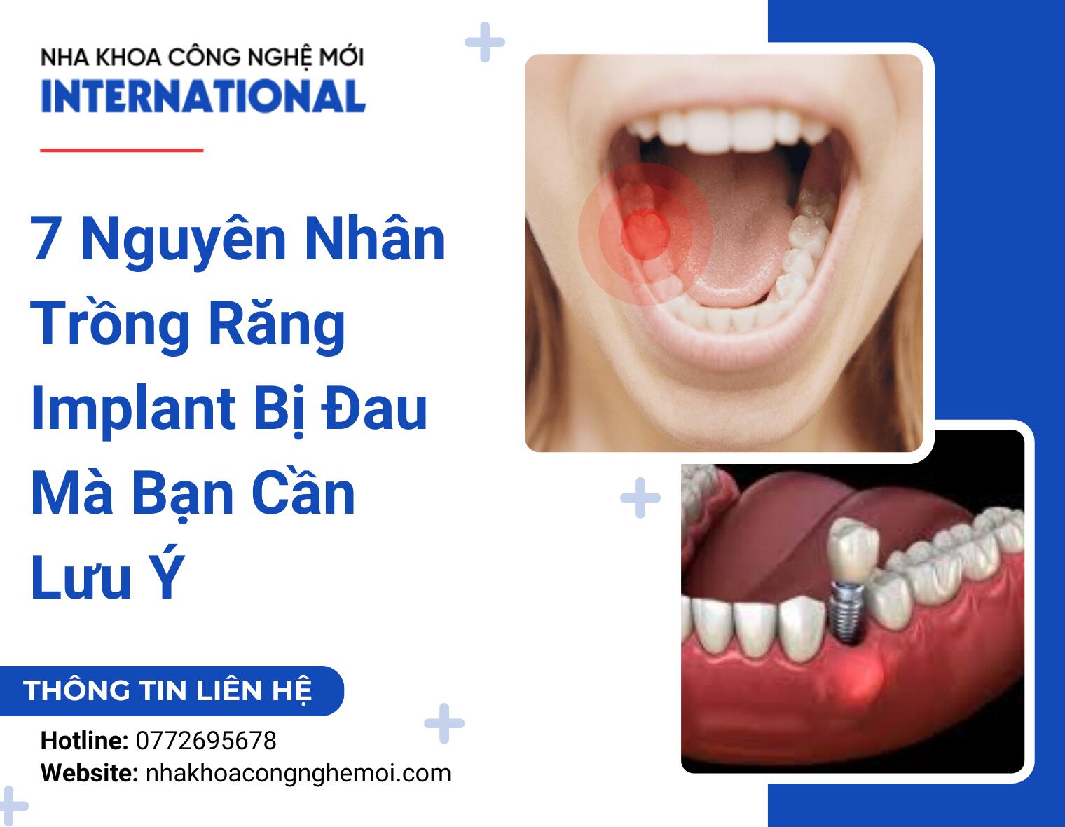 7 Nguyên Nhân Trồng Răng Implant Bị Đau Mà Bạn Cần Lưu Ý