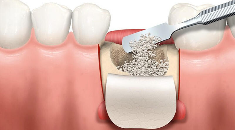 Cấy xương trồng implant là gì?