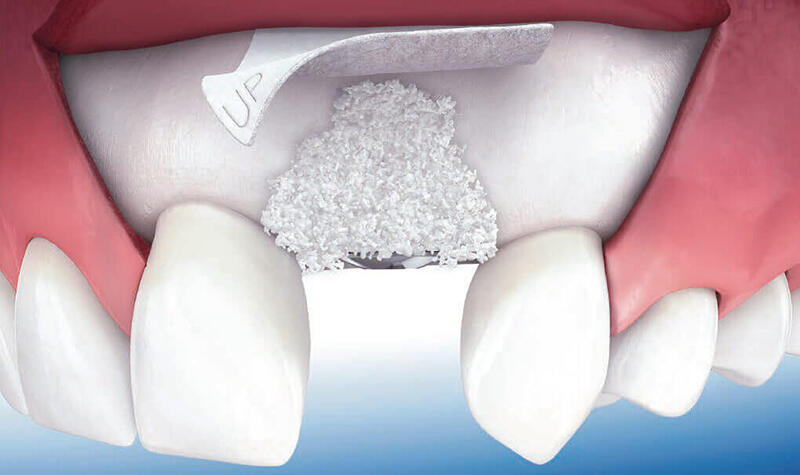Khi nào nên và không nên cấy xương trồng implant?