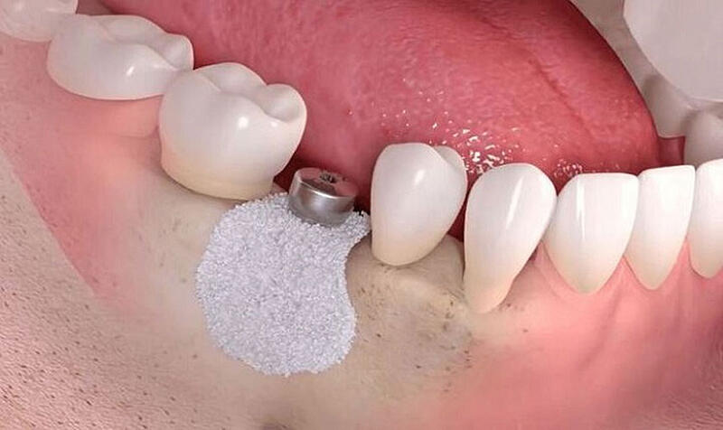 Khi nào cần ghép xương khi trồng Implant?