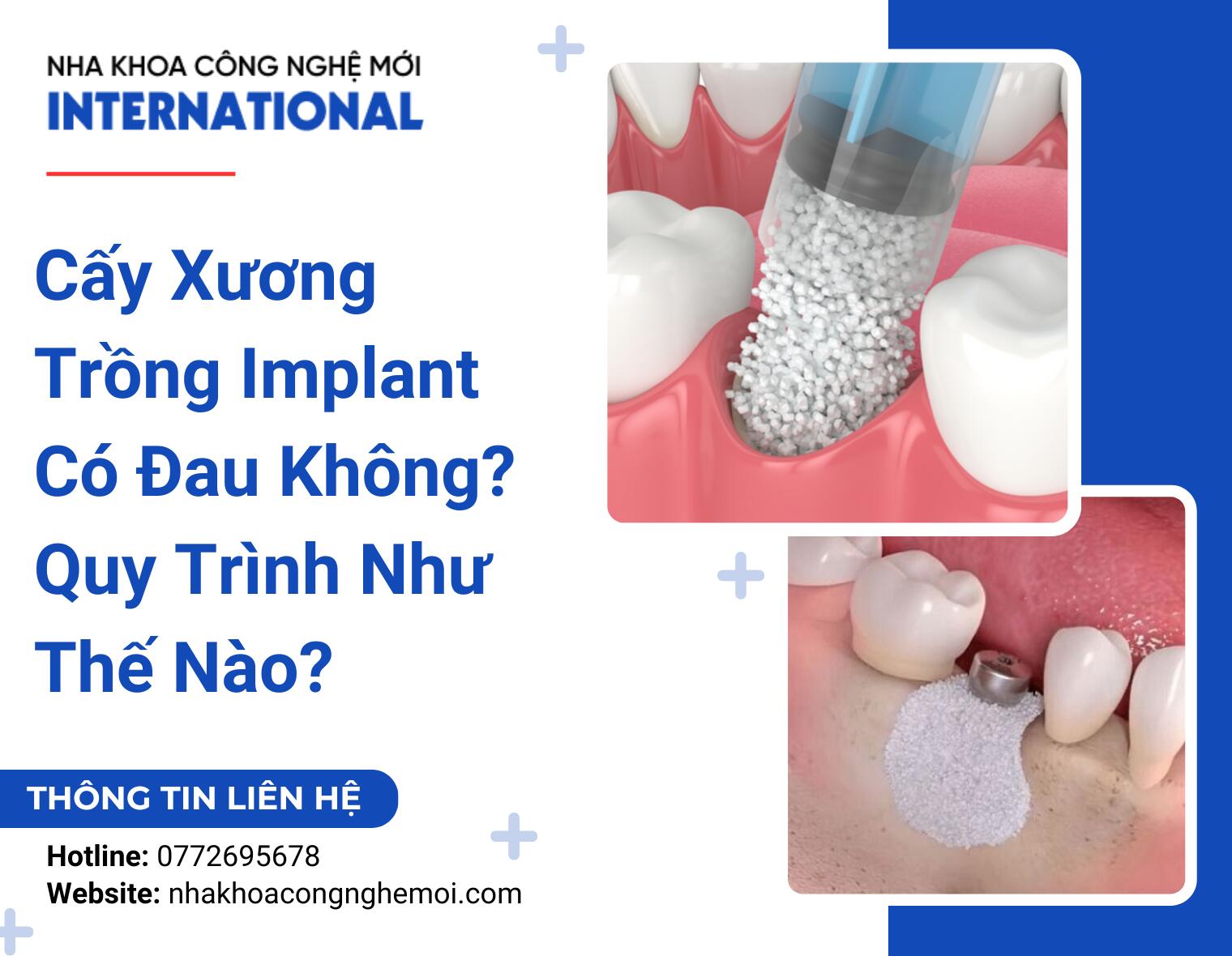 Cấy Xương Trồng Implant Có Đau Không? Quy Trình Như Thế Nào?