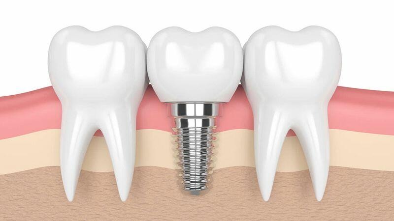 Trồng răng Implant