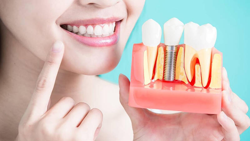 Yếu tố ảnh hưởng đến chi phí trồng răng hàm giả