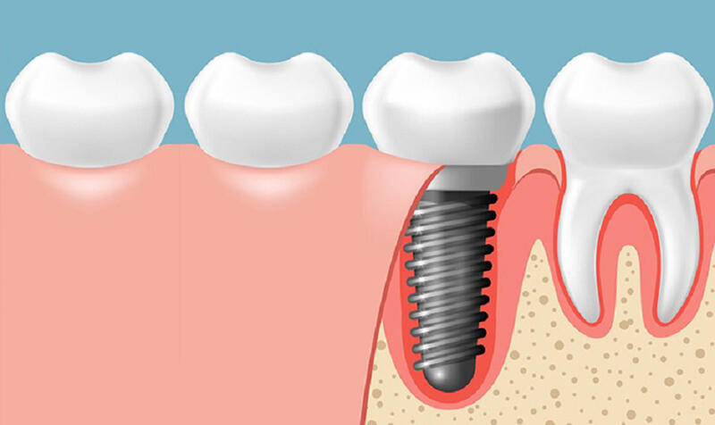 Một số lưu ý giúp tiết kiệm chi phí trồng răng