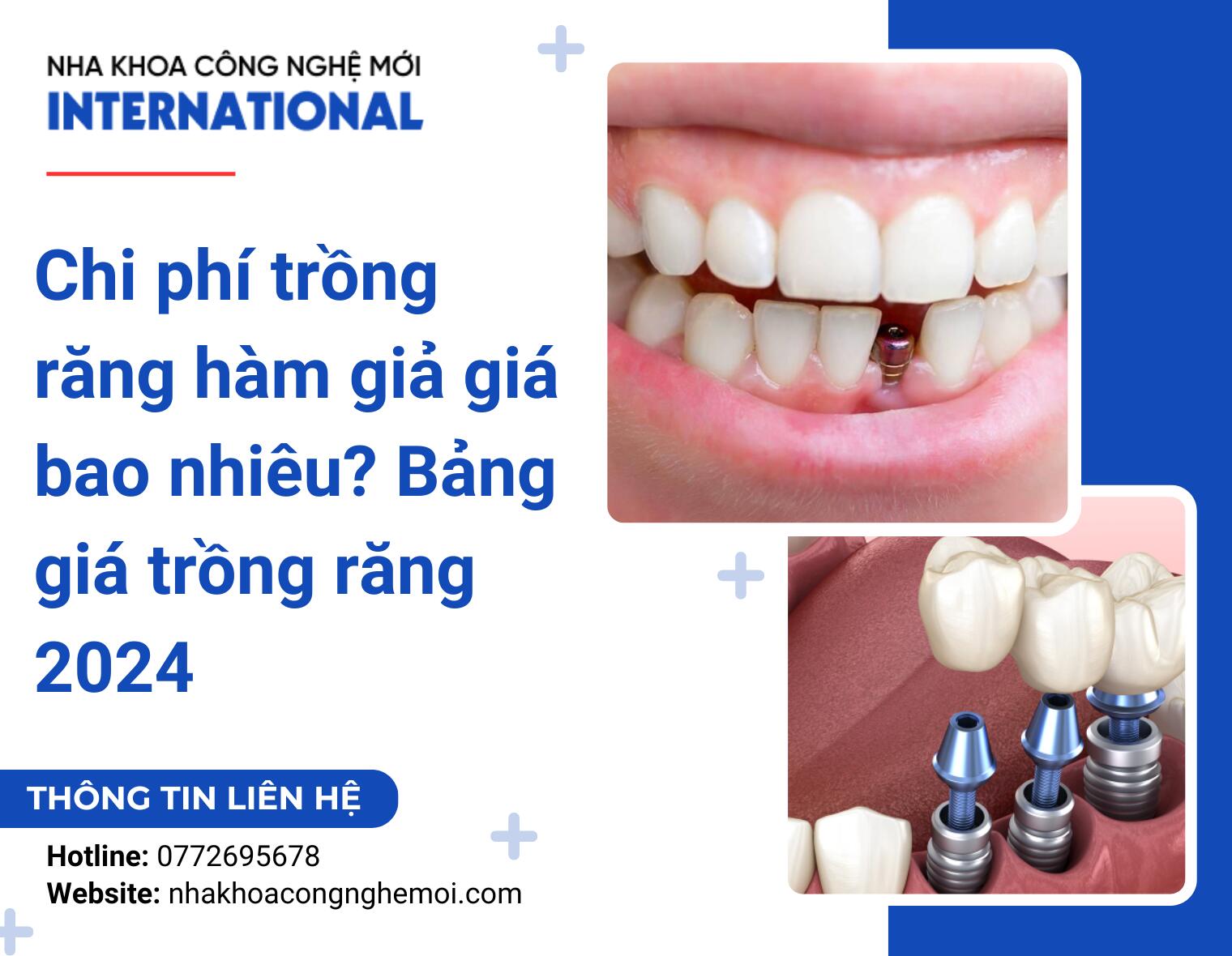 Chi phí trồng răng hàm giả giá bao nhiêu? Bảng giá trồng răng 2024