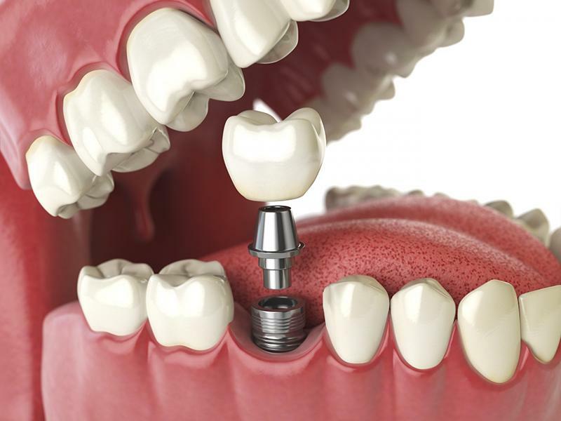 Trồng răng Implant có an toàn không?