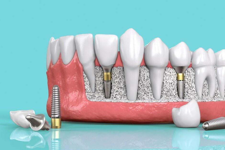 7 sự thật về răng implant có thể bạn chưa biết