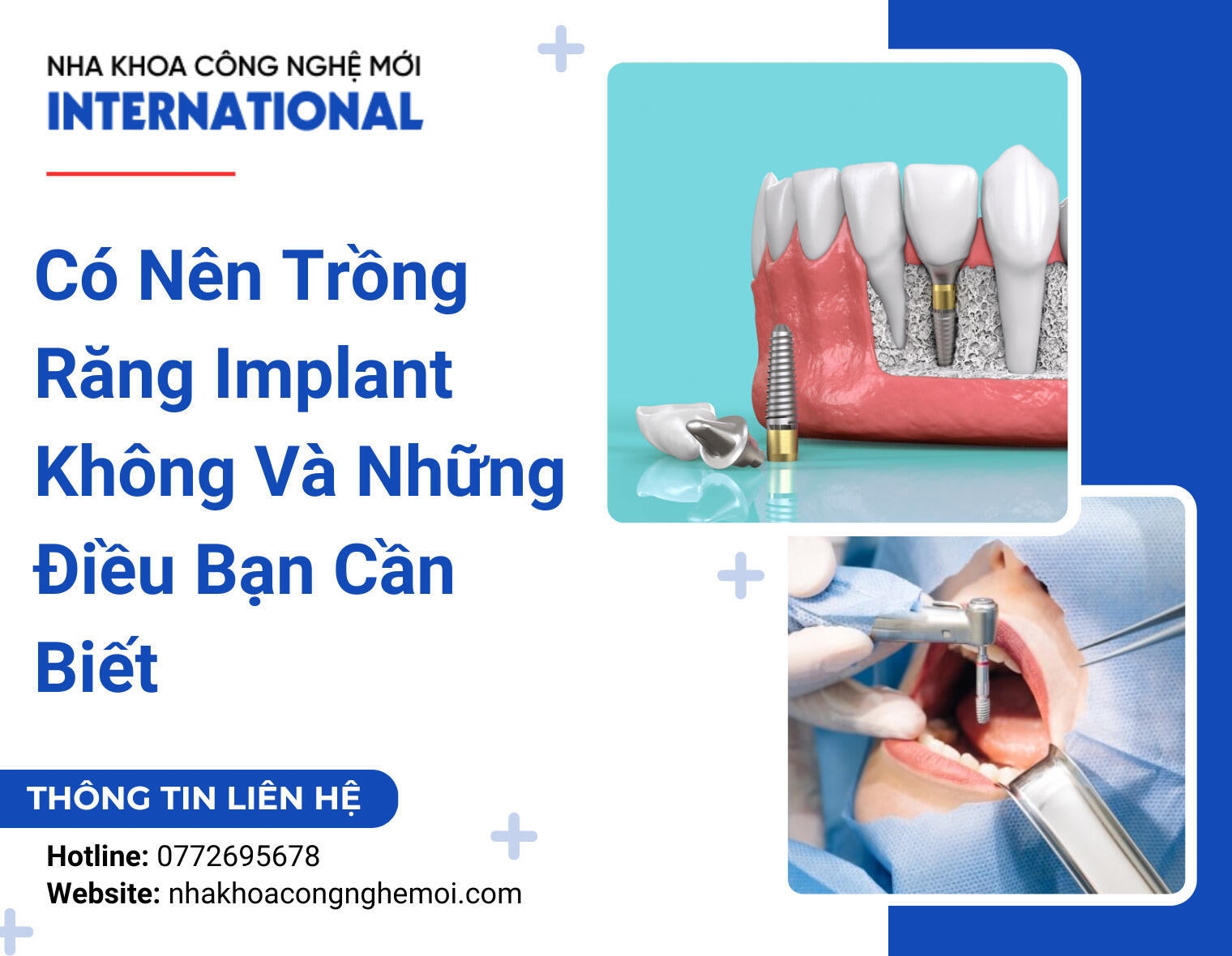 Có Nên Trồng Răng Implant Không Và Những Điều Bạn Cần Biết