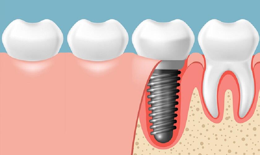 Công nghệ răng Implant là gì?