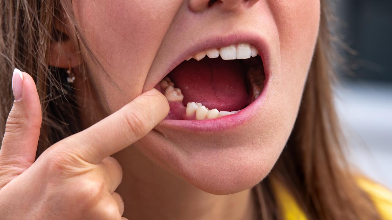 Mất răng đơn lẻ