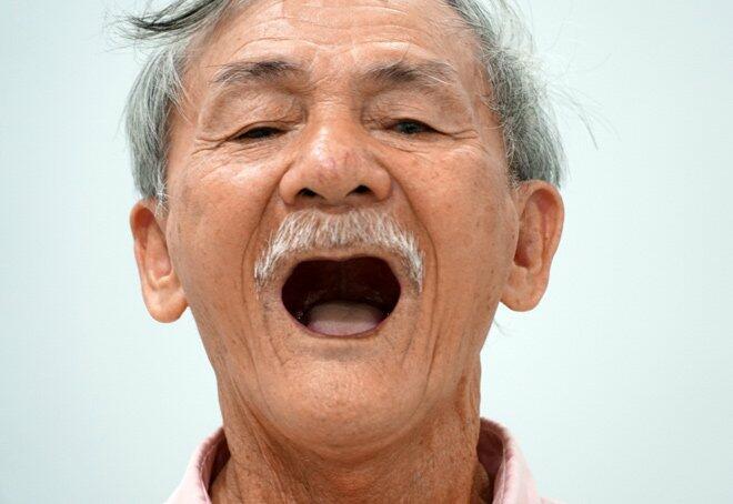 Mất toàn bộ răng