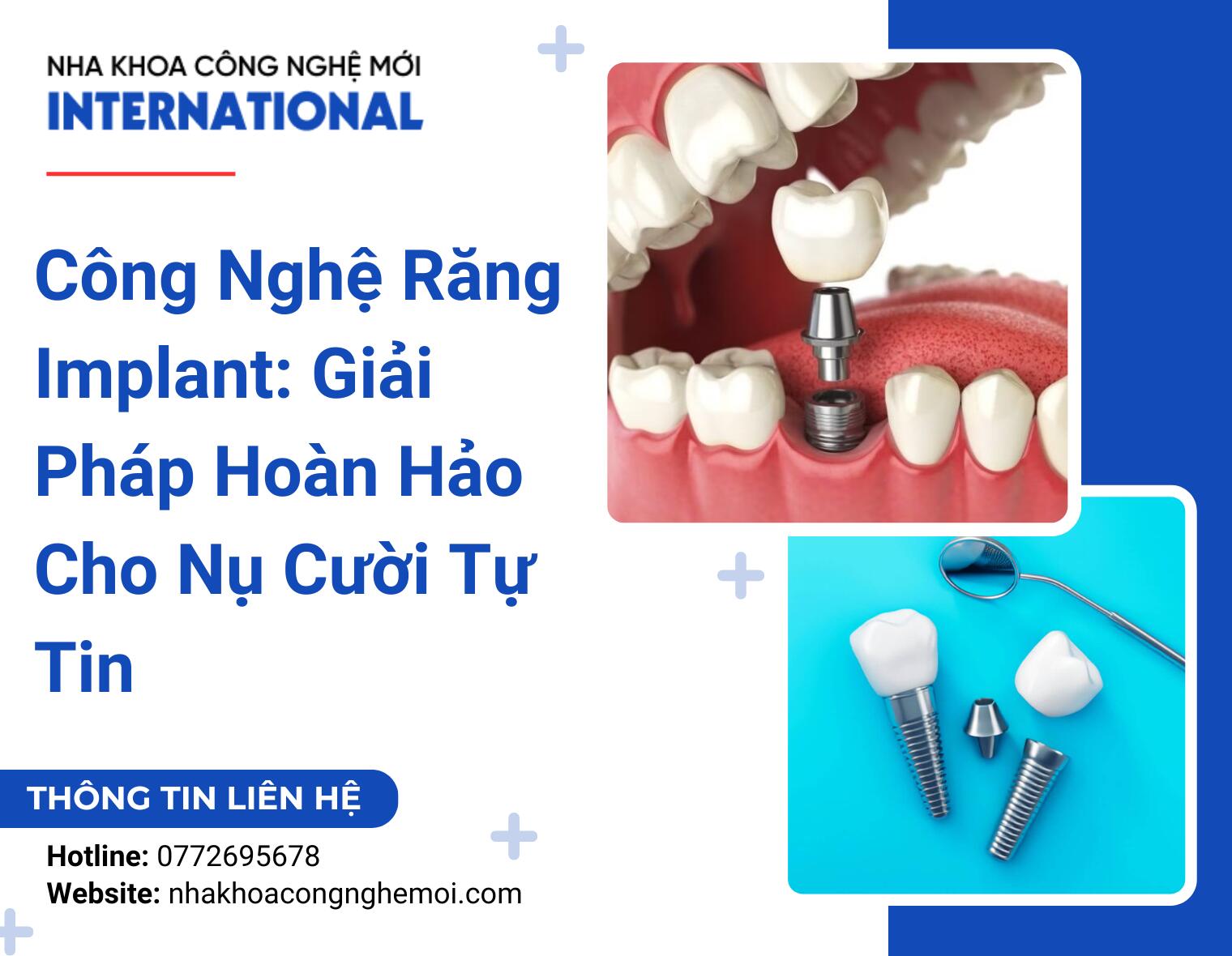 Công Nghệ Răng Implant: Giải Pháp Hoàn Hảo Cho Nụ Cười Tự Tin