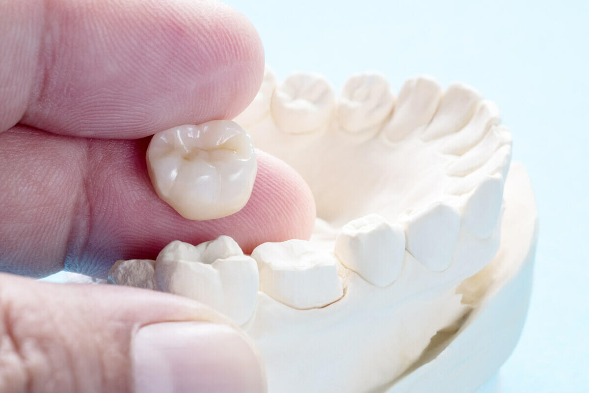 Gắn răng tạm khi bọc sứ có ăn uống bình thường được không?
