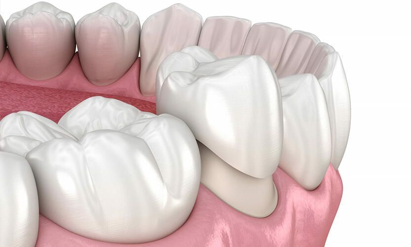 Lưu ý gì khi gắn răng tạm sau bọc sứ