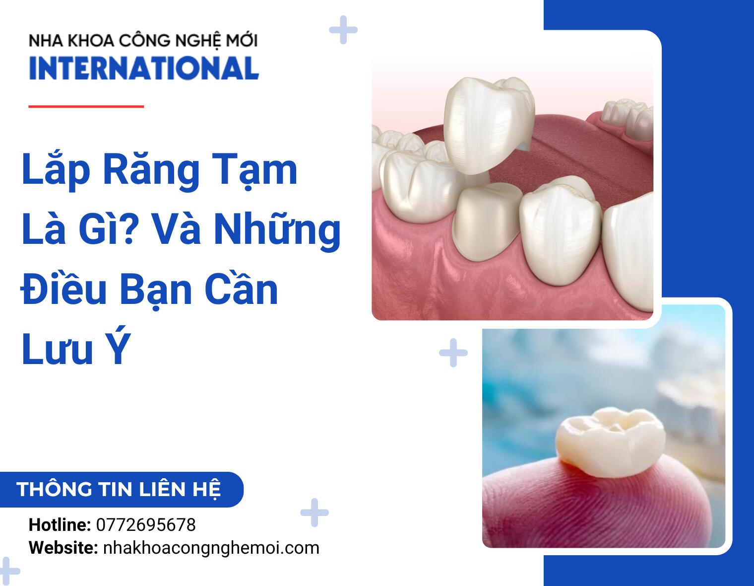 Lắp Răng Tạm Là Gì? Và Những Điều Bạn Cần Lưu Ý