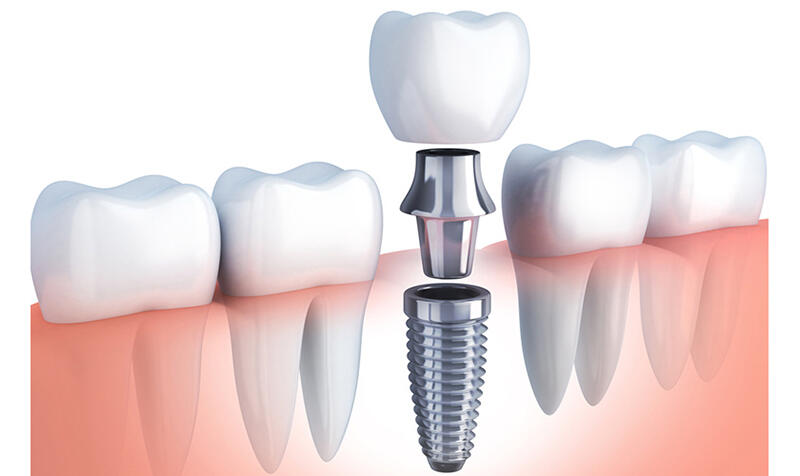 Mất răng lâu năm có trồng implant được không?