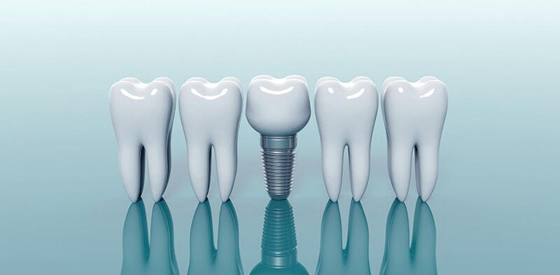 Trồng răng sau nhiều năm mất răng cần chú ý điều gì?