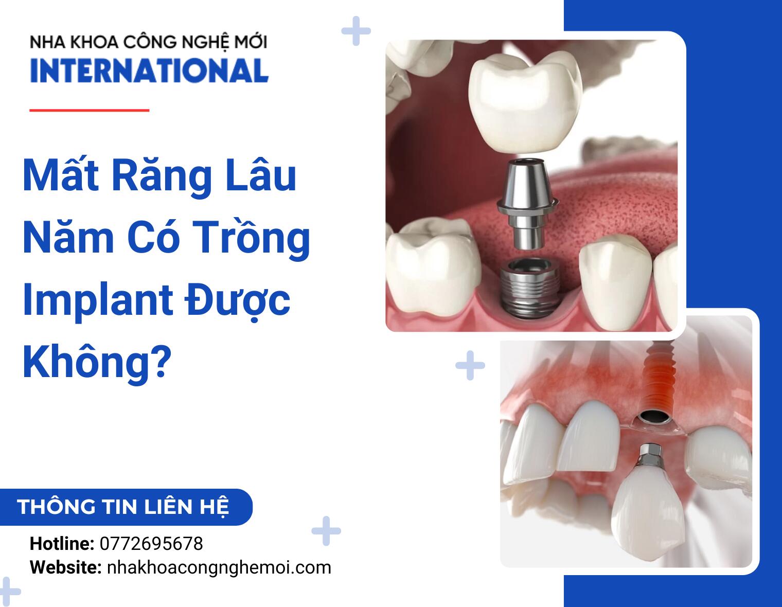 Mất Răng Lâu Năm Có Trồng Implant Được Không?