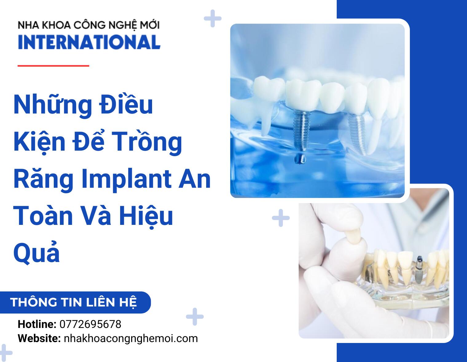Những Điều Kiện Để Trồng Răng Implant An Toàn Và Hiệu Quả