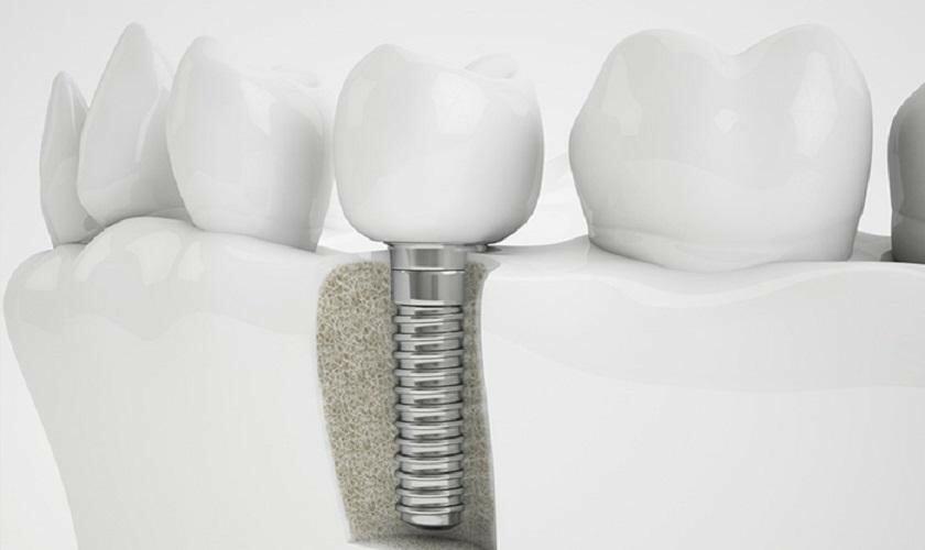Thông tin về kỹ thuật cấy ghép - trồng răng Implant