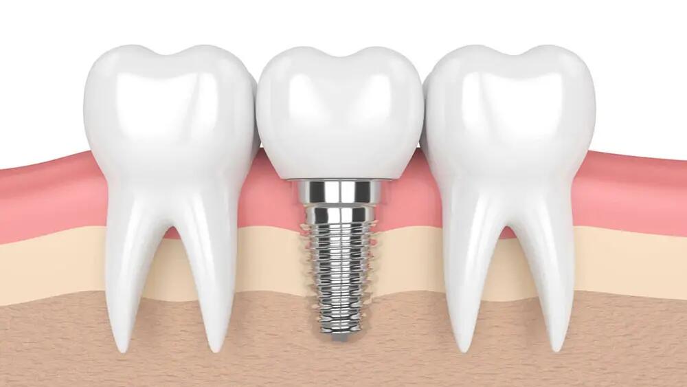 Ba nhược điểm của trồng răng Implant