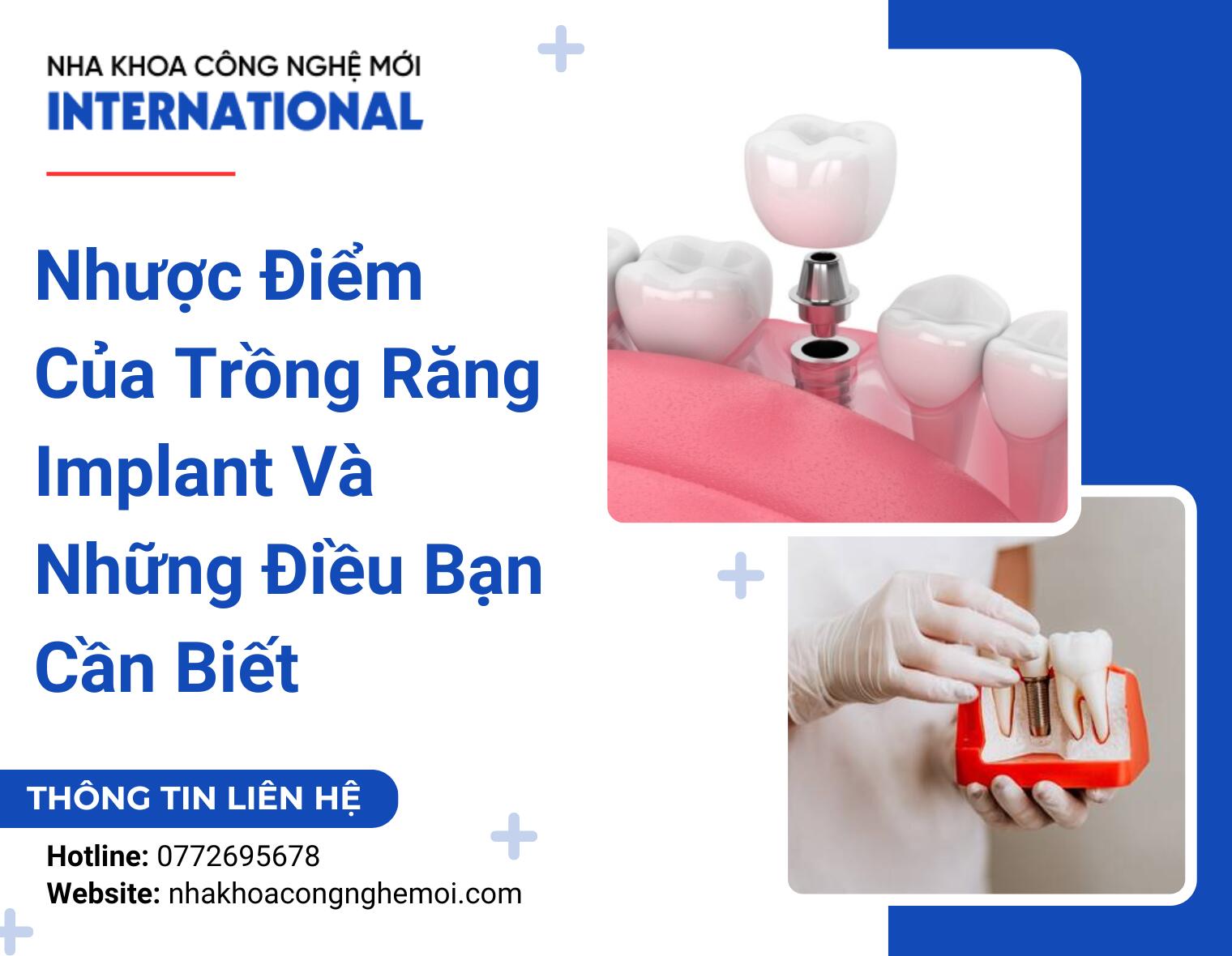 Nhược Điểm Của Trồng Răng Implant Và Những Điều Bạn Cần Biết