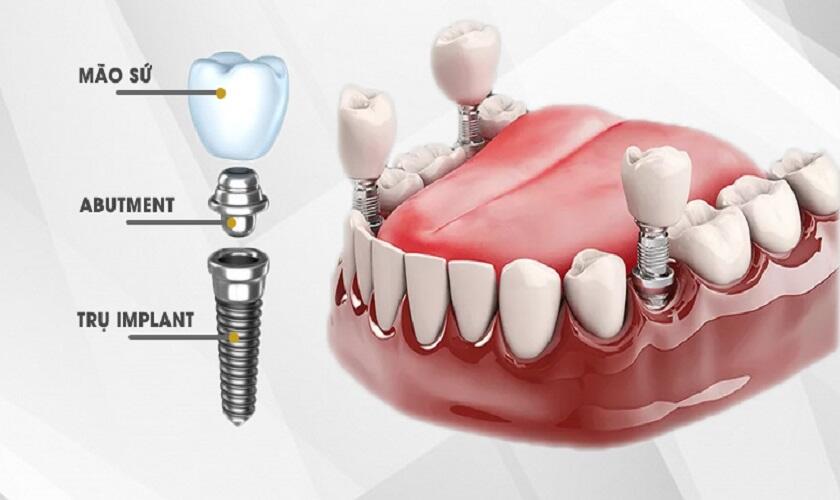 Trồng răng Implant là gì?