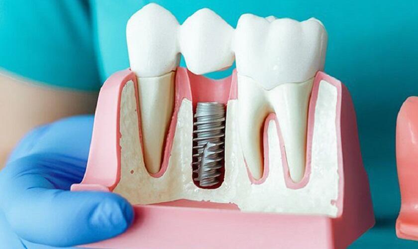 Lưu ý gì khi thực hiện trồng răng Implant?