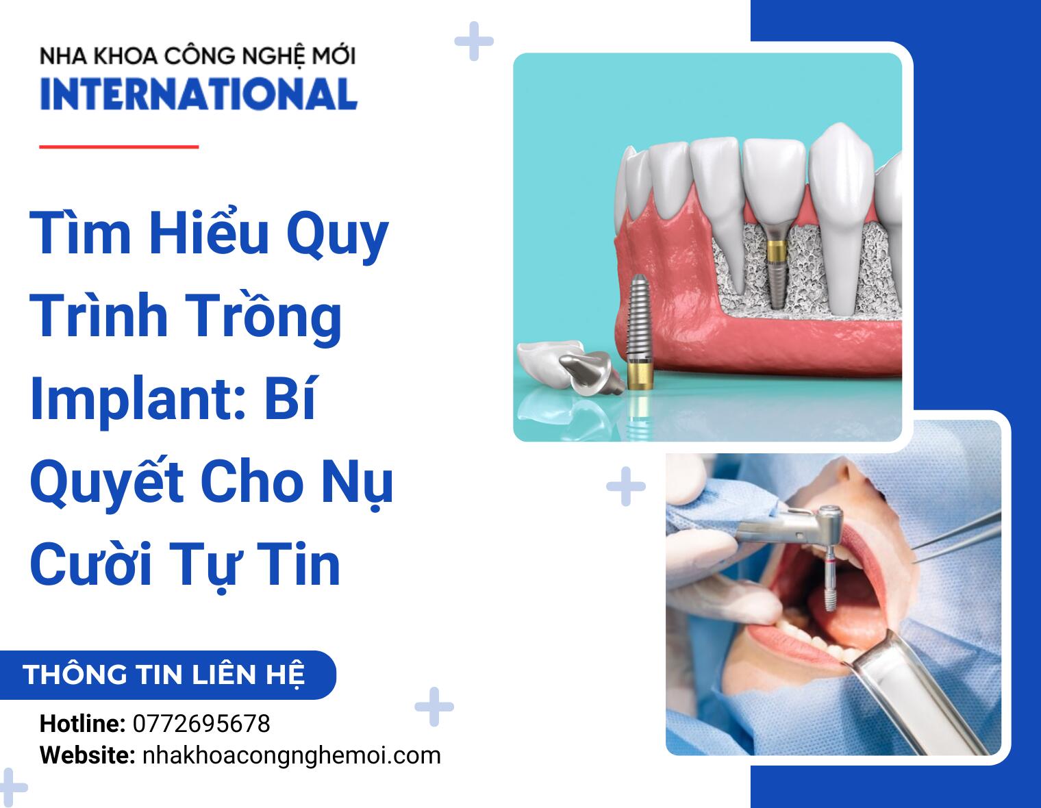 Tìm Hiểu Quy Trình Trồng Implant: Bí Quyết Cho Nụ Cười Tự Tin