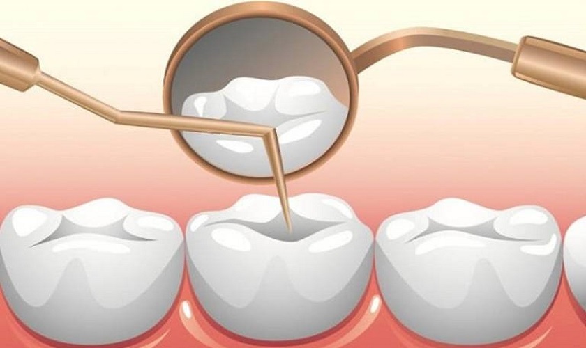 Trám răng thẩm mỹ