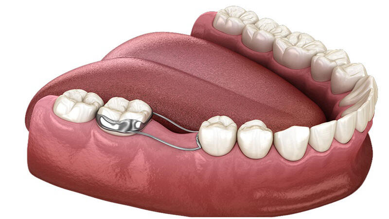 Giải pháp khi trẻ bị mất răng sớm