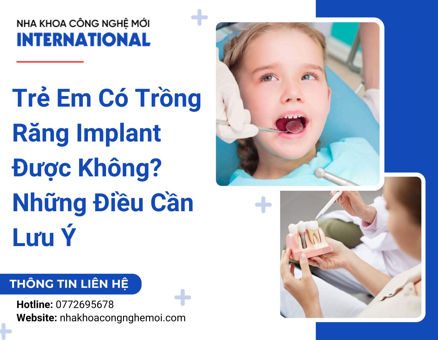 Trẻ Em Có Trồng Răng Implant Được Không? Những Điều Cần Lưu Ý