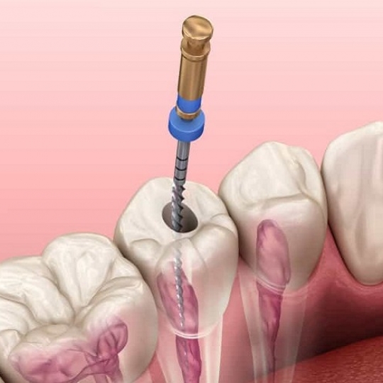 ĐIỀU TRỊ VIÊM TỦY RĂNG